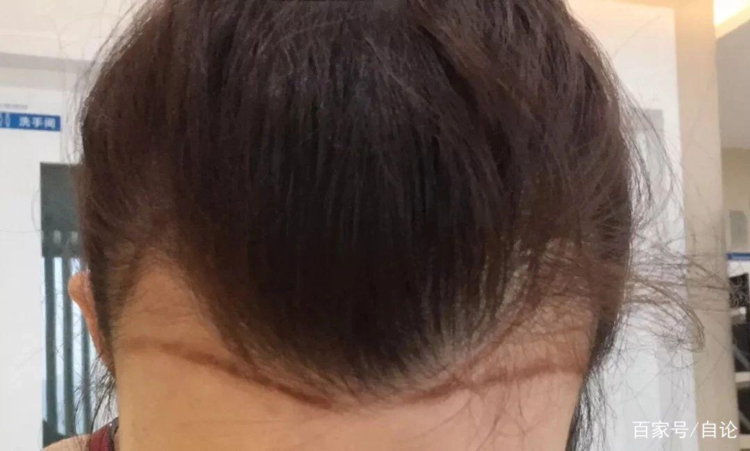 关于脱发与再生，一个关于青春与未来的故事，脱发与再生，青春与未来的博弈