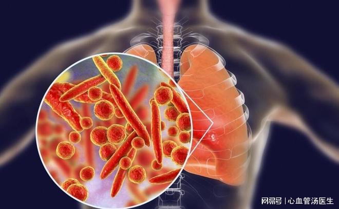 集团菌感染,一种不容忽视的疾病,集团菌感染,不容忽视的疾病威胁